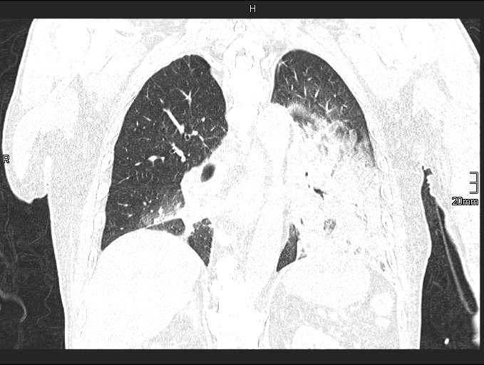 Acute aspiration pneumonitis (Radiopaedia 55642-62166 Coronal lung window 66).jpg