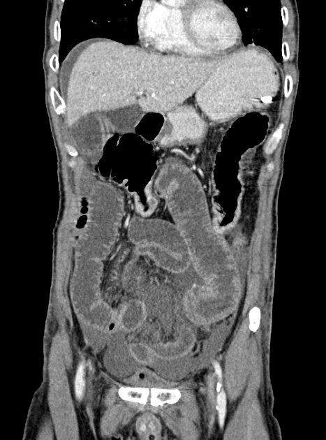 Acute bowel ischemia (Radiopaedia 87695-104114 Coronal C+ portal venous phase 141).jpg