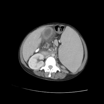 Acute calculous cholecystitis in patient with osteopetrosis (Radiopaedia 77871-90159 Axial C+ portal venous phase 44).jpg