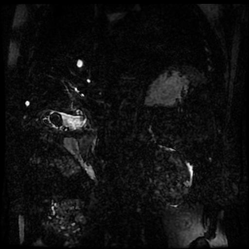 Acute cholecystitis and biliary hamartomas (Radiopaedia 86231-102240 E 48).jpg