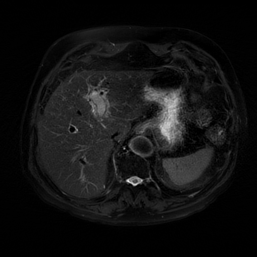 File:Acute cholecystitis complicated by pylephlebitis (Radiopaedia 65782-74915 Axial T2 fat sat 13).jpg