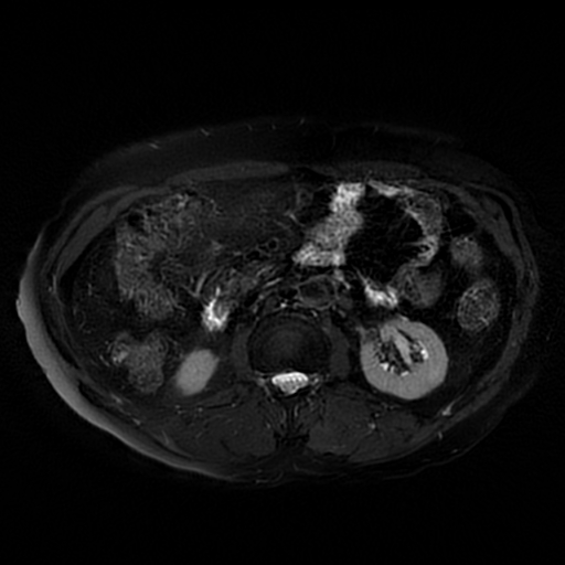 File:Acute cholecystitis complicated by pylephlebitis (Radiopaedia 65782-74915 Axial T2 fat sat 32).jpg
