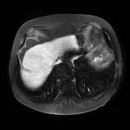 File:Acute cholecystitis complicated by pylephlebitis (Radiopaedia 65782-74915 Axial arterioportal phase T1 C+ fat sat 9).jpg