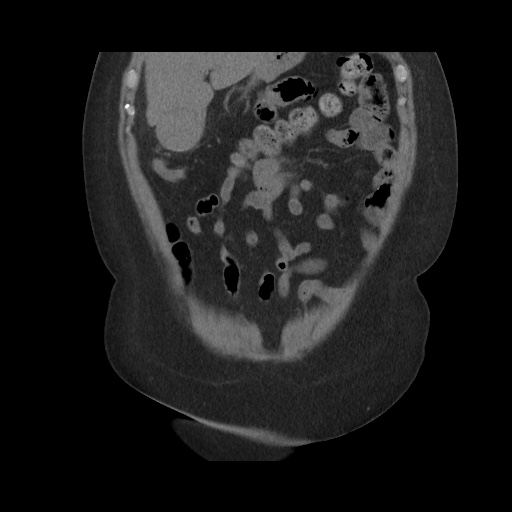File:Acute cholecystitis with tensile fundus sign (Radiopaedia 71394-81723 Coronal non-contrast 39).jpg