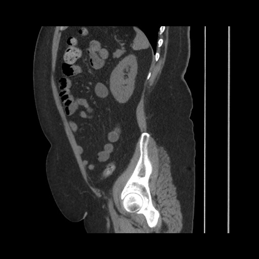 Acute cholecystitis with tensile fundus sign (Radiopaedia 71394-81723 Sagittal non-contrast 120).jpg