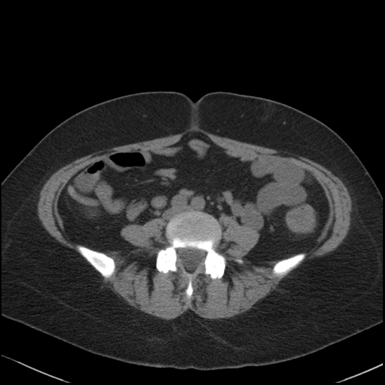 Acute colonic hemorrhage in ulcerative colitis (Radiopaedia 77415-89538 Axial non-contrast 85).jpg