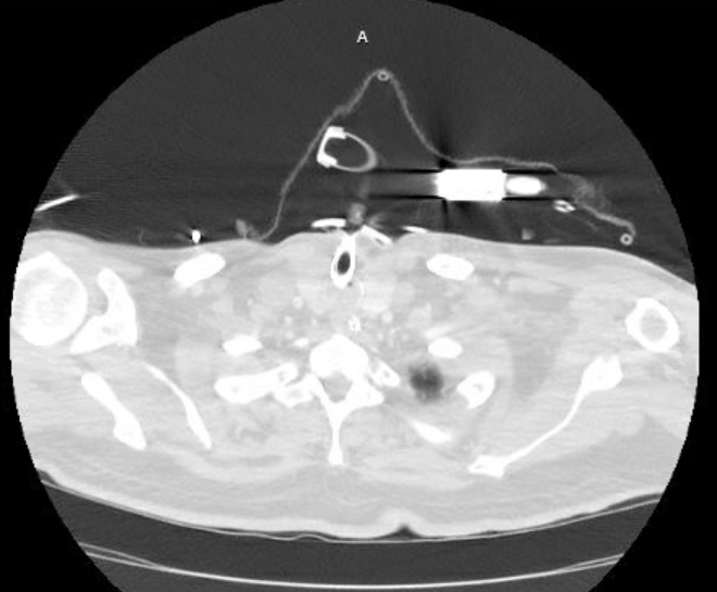Acute cor pulmonale (ultrasound) (Radiopaedia 83508-98818 Axial lung window 2).jpg
