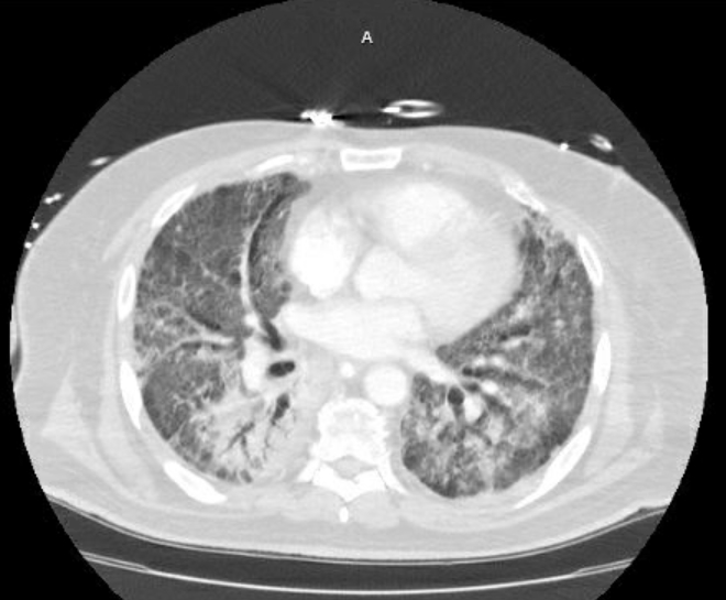Acute cor pulmonale (ultrasound) (Radiopaedia 83508-98818 Axial lung window 51).jpg