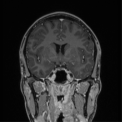 Acute disseminated encephalomyelitis (ADEM) (Radiopaedia 65319-74349 Coronal T1 C+ 31).png