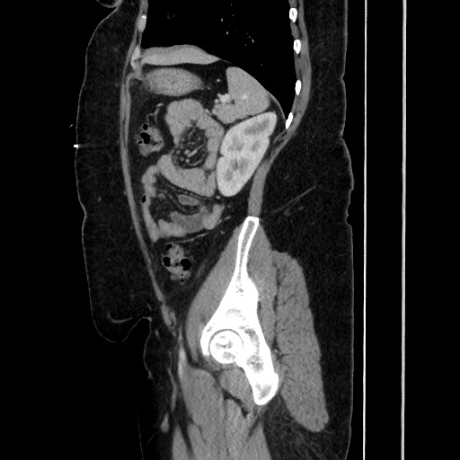Acute diverticulitis - transverse colon (Radiopaedia 87063-103327 Sagittal C+ portal venous phase 162).jpg
