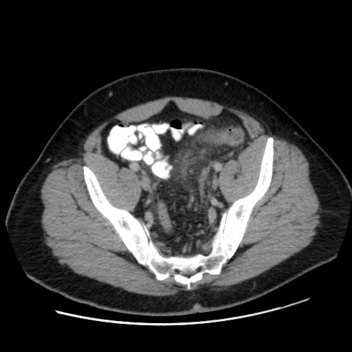 Acute diverticulitis with localized perforation (Radiopaedia 41296-44113 Axial C+ portal venous phase 74).jpg
