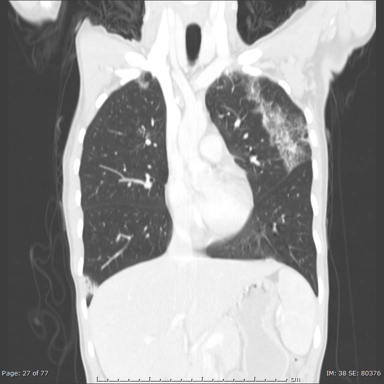 Acute eosinophilic pneumonia (Radiopaedia 48211-53073 Coronal lung window 17).jpg