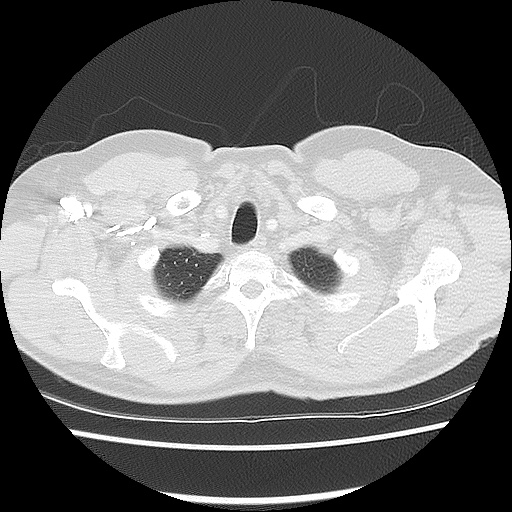 Acute epicardial fat necrosis (Radiopaedia 42327-45440 Axial lung window 10).jpg