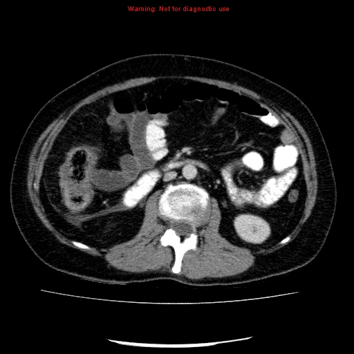 Acute gangrenous cholecystitis (Radiopaedia 10123-10661 Axial C+ portal venous phase 49).jpg