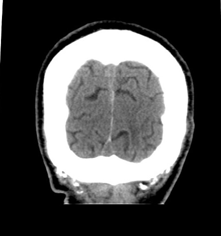 Acute left anterior cerebral artery territory infarction (Radiopaedia 51785-57578 Coronal non-contrast 54).jpg