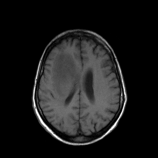 File:Acute necrotizing toxoplasma encephalitis (Radiopaedia 10683-11149 Axial T1 6).jpg