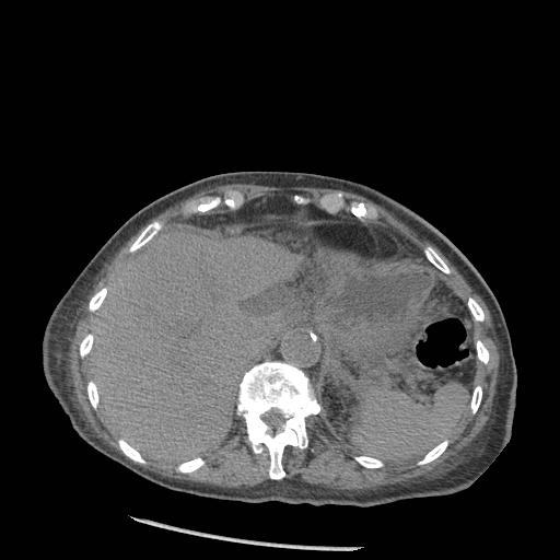 Acute on chronic pancreatitis (Radiopaedia 13233-13244 Axial non-contrast 11).jpg