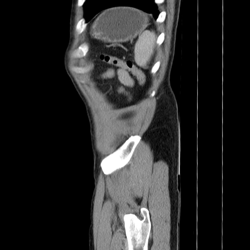 Acute pancreatitis (Radiopaedia 22572-22596 Sagittal C+ portal venous phase 49).jpg