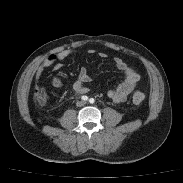 Acute pancreatitis (Radiopaedia 26663-26813 Axial C+ arterial phase 62).jpg