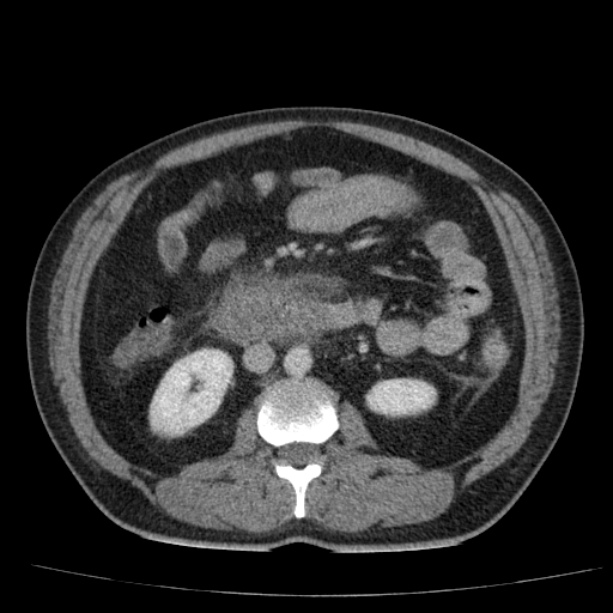 Acute pancreatitis (Radiopaedia 26663-26813 Axial C+ portal venous phase 42).jpg