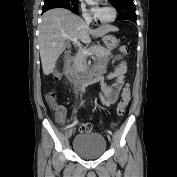 Acute pancreatitis (Radiopaedia 26663-26813 Coronal C+ portal venous phase 31).jpg
