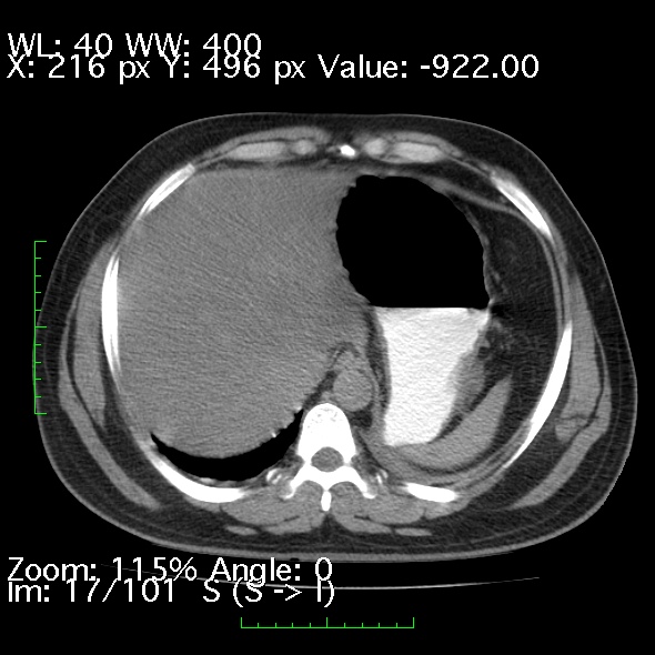 File:Acute pancreatitis (Radiopaedia 34043-35276 Axial non-contrast 17).jpg