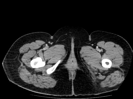 Acute pancreatitis (Radiopaedia 69236-79012 Axial C+ portal venous phase 95).jpg