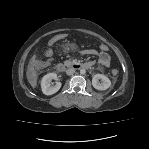 Acute pancreatitis (Radiopaedia 80007-93285 Axial C+ portal venous phase 90).jpg
