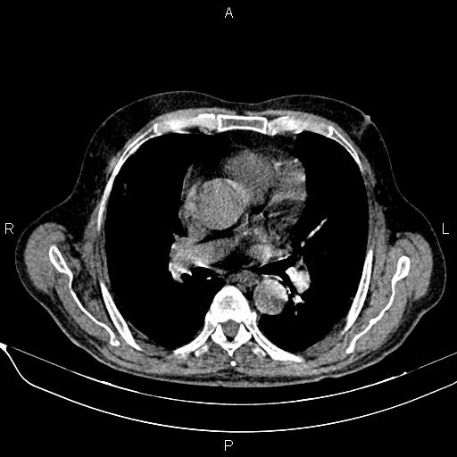 File:Acute pancreatitis (Radiopaedia 85146-100701 Axial non-contrast 4).jpg