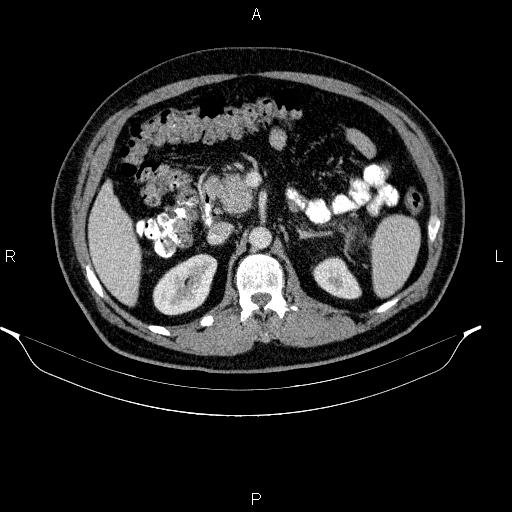 Acute pancreatitis (Radiopaedia 85390-101010 Axial C+ portal venous phase 39).jpg