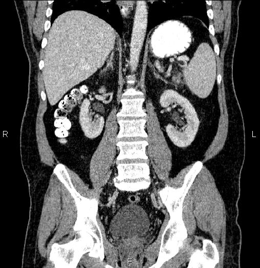 Acute pancreatitis (Radiopaedia 85390-101010 Coronal C+ portal venous phase 46).jpg