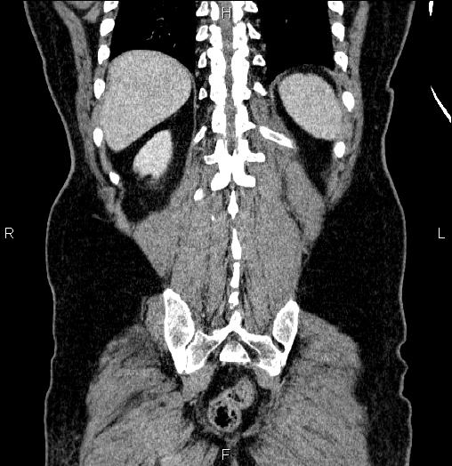 Acute pancreatitis (Radiopaedia 85390-101010 Coronal C+ portal venous phase 62).jpg