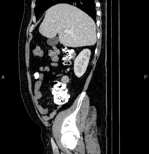 Acute pancreatitis (Radiopaedia 85390-101010 Sagittal C+ portal venous phase 22).jpg