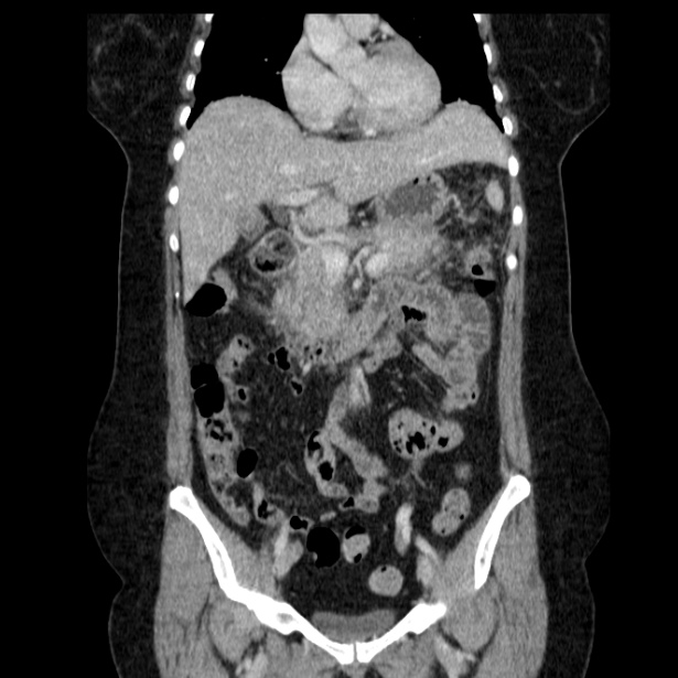 Acute pancreatitis - Balthazar C (Radiopaedia 26569-26714 Coronal C+ portal venous phase 30).jpg
