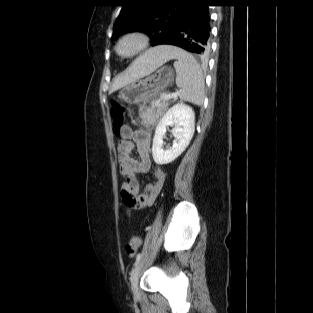 Acute pancreatitis - Balthazar C (Radiopaedia 26569-26714 Sagittal C+ portal venous phase 49).jpg