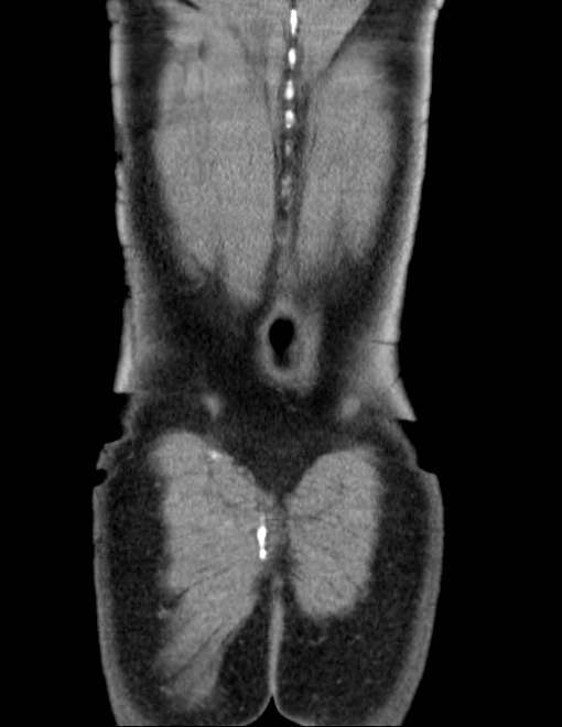 Acute pancreatitis - Balthazar E (Radiopaedia 23080-23110 Coronal C+ portal venous phase 78).jpg