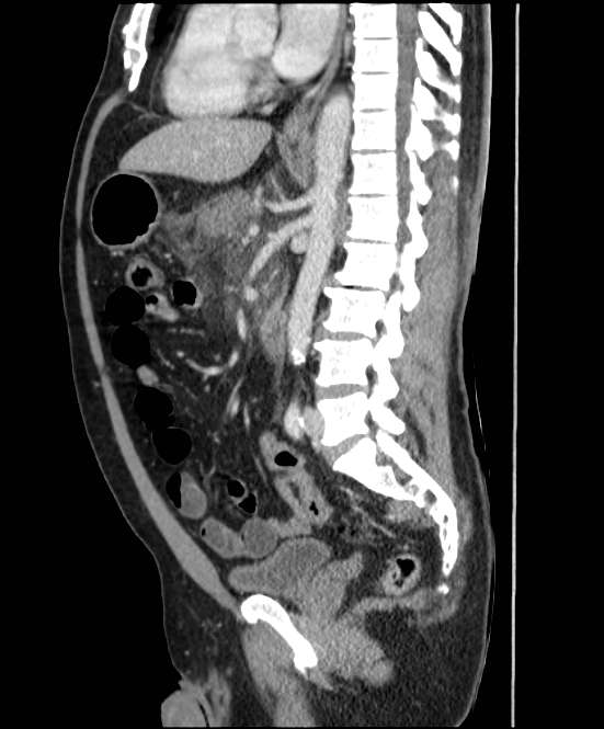 Acute pancreatitis - Balthazar E (Radiopaedia 23080-23110 Sagittal C+ portal venous phase 53).jpg