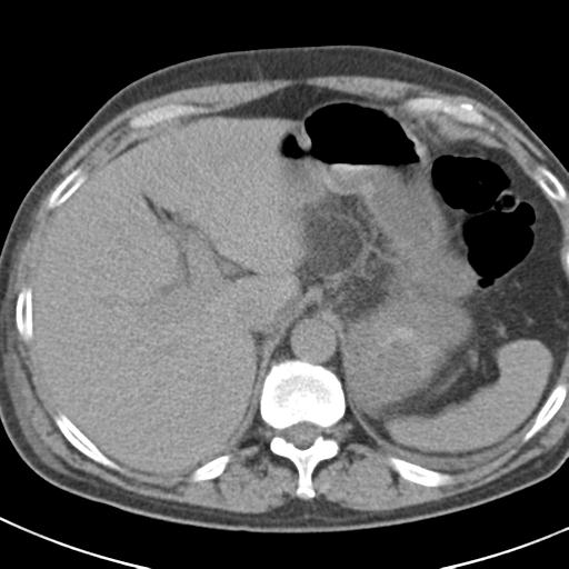 File:Acute pancreatitis and walled-off necrosis (Radiopaedia 29888-30403 Axial non-contrast 13).jpg