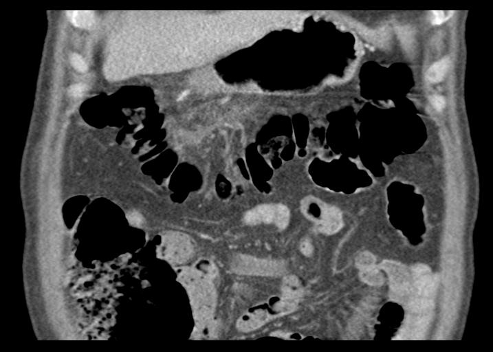 Acute pancreatitis and walled-off necrosis (Radiopaedia 29888-30403 Coronal C+ portal venous phase 16).jpg