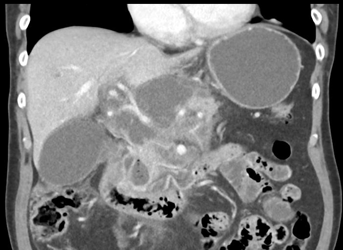 Acute pancreatitis and walled-off necrosis (Radiopaedia 29888-30404 Coronal C+ portal venous phase 24).jpg
