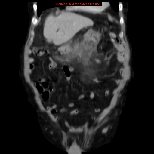 Acute pancreatitis with incidental pancreatic lipoma (Radiopaedia 10190-10730 Coronal C+ portal venous phase 18).jpg