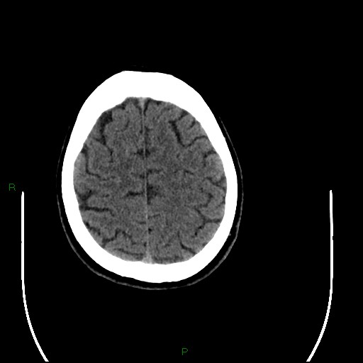 File:Acute posterior cerebral artery territory infarct (Radiopaedia 79329-92393 Axial non-contrast 90).jpg