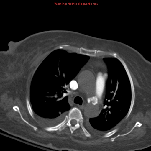 File:Acute pulmonary embolism (Radiopaedia 13286-13289 Axial C+ CTPA 26).jpg