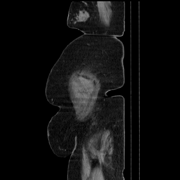 Acute pyelonephritis (Radiopaedia 25657-25837 Sagittal renal parenchymal phase 74).jpg
