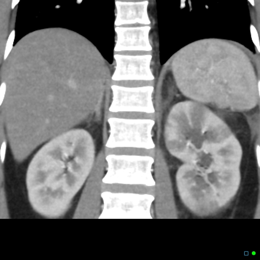 File:Acute pyelonephritis and emphysematous pyonephrosis (Radiopaedia 27893-28128 Coronal renal cortical phase 12).jpg