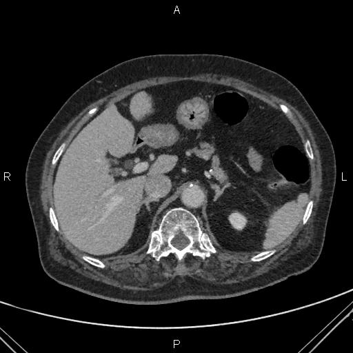 File:Acute renal artery occlusion (Radiopaedia 86586-102682 Axial C+ portal venous phase 17).jpg