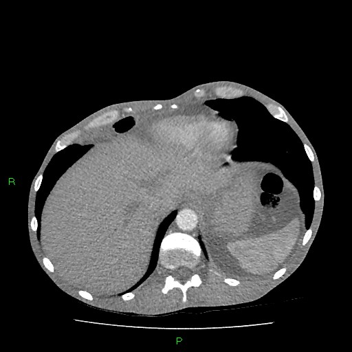 File:Acute right lung abscess (Radiopaedia 34806-36258 Axial C+ arterial phase 162).jpg