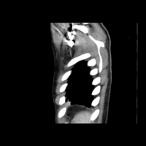 Acute segmental pulmonary emboli and pulmonary infarction (Radiopaedia 62264-70444 Sagittal C+ CTPA 59).jpg