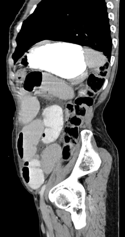 Acute small bowel (ileal) volvulus (Radiopaedia 71740-82139 Sagittal C+ portal venous phase 52).jpg
