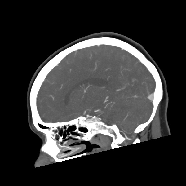 File:Acute subarachnoid hemorrhage and accessory anterior cerebral artery (Radiopaedia 69231-79009 Sagittal C+ arterial phase 43).jpg